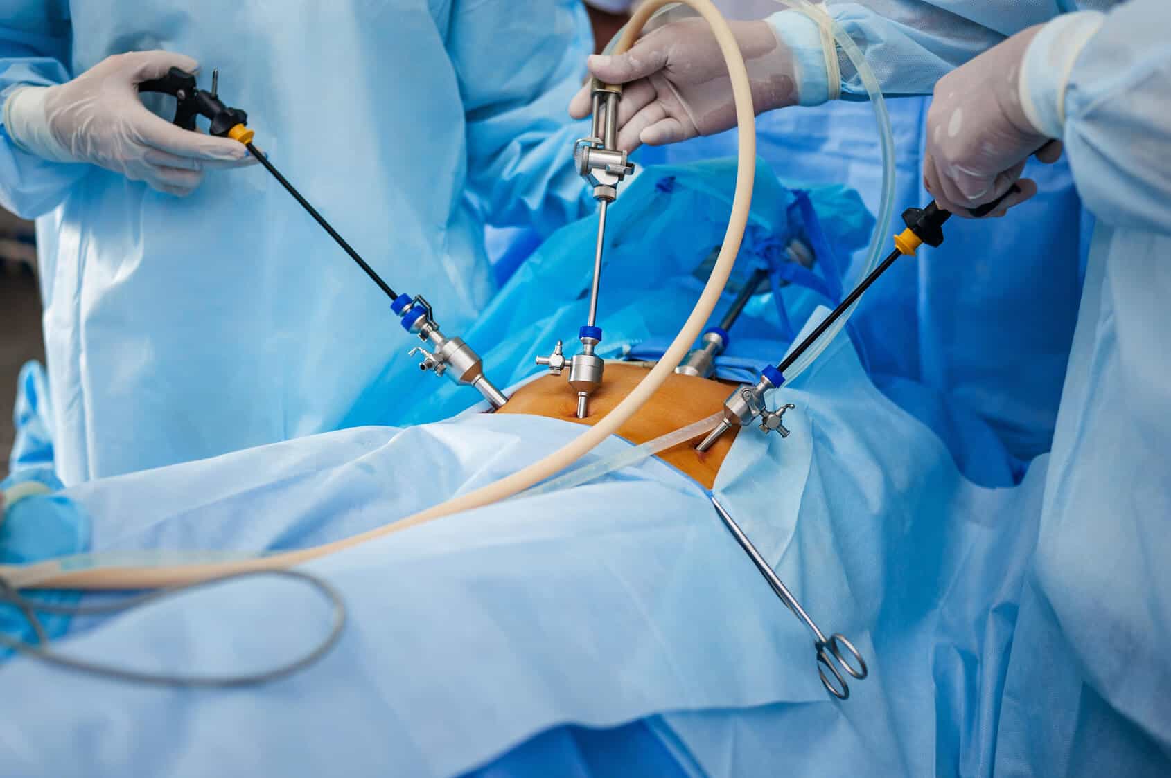 What Is Laparoscopy