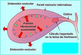 cirugia-de-vesicula