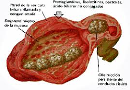 colecistitis-aguda