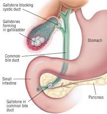 coledocolitiasis