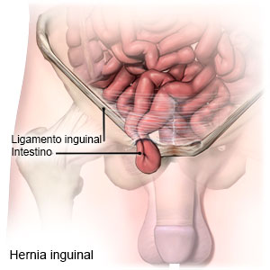 hernia-inguinal