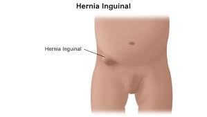 imagen-3-sintomas-de-hernia