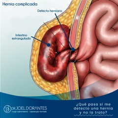 imagen-4-hernia-complicada