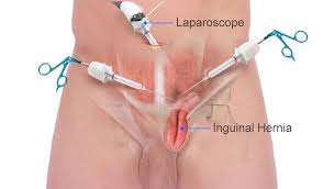 imagen-6-cirugia-laparoscopica