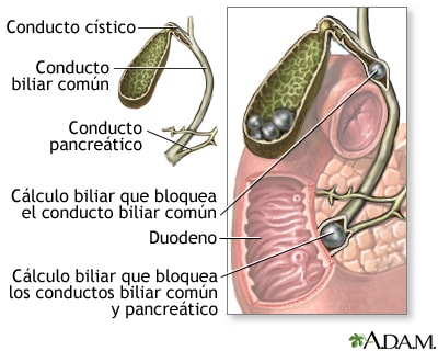 operacion-de-vesicula