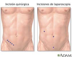 sintomas-de-apendicitis