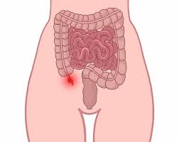 sintomas-de-apendicitis